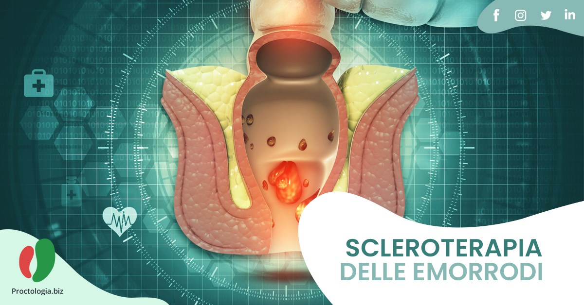 Scleroterapia delle Emorroidi