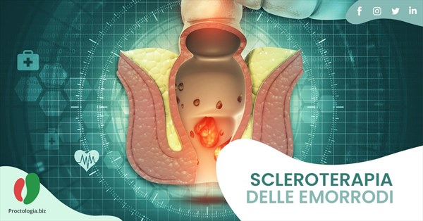 Scleroterapia delle Emorroidi